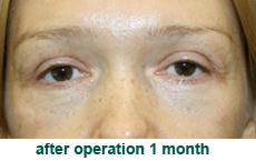 plastic-surgery-blepharoplasty